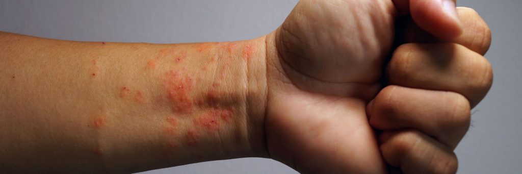 Medical atopic eczema allergy texture of ill human skin, dermatitis