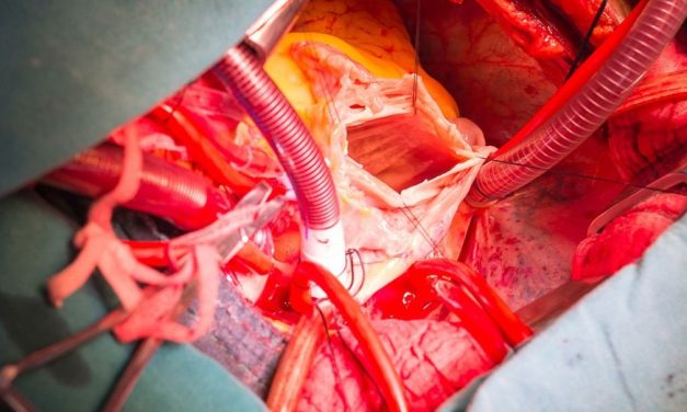 RELIEVE-HF: Interatrial Shunt May Prove Advantageous for Patients With HFrEF