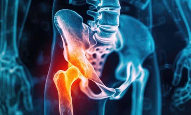 Progressive Resistance Training Not Superior for Hip Osteoarthritis