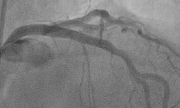 Intravascular image guidance during percutaneous coronary intervention lowers risk of death and myocardial infarction