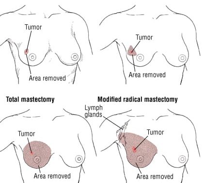 Omitting Axillary Dissection in Breast Cancer with Sentinel-Node Metastases