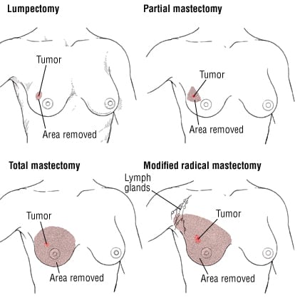 Omitting Axillary Dissection in Breast Cancer with Sentinel-Node Metastases