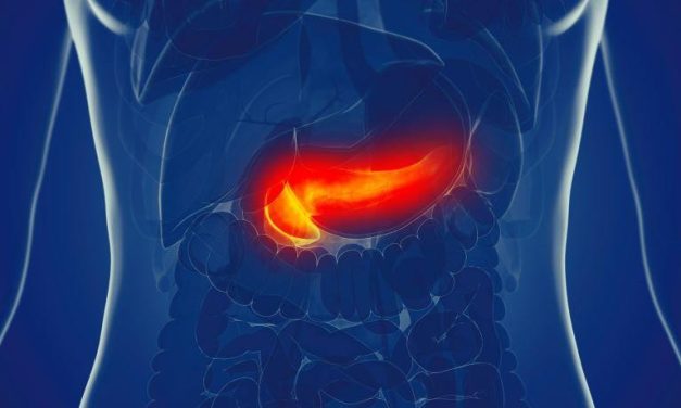 Subclassification Can Tailor Surveillance for Pancreatic Adenocarcinoma