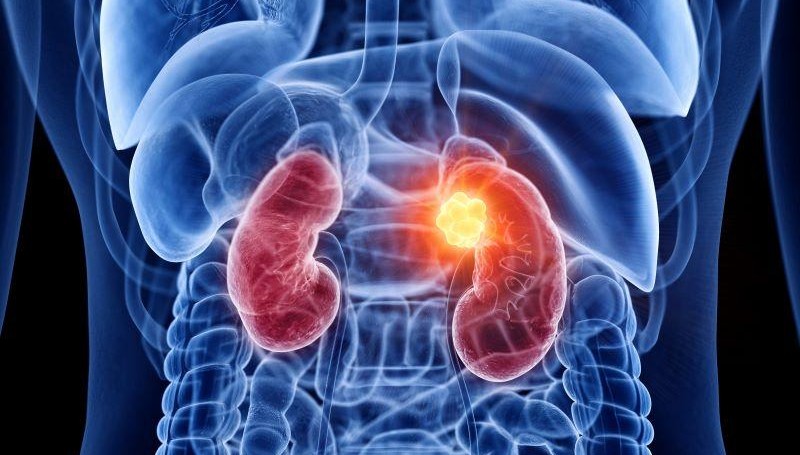 Improvement Seen in Survival With Adjuvant Pembrolizumab in Kidney Cancer
