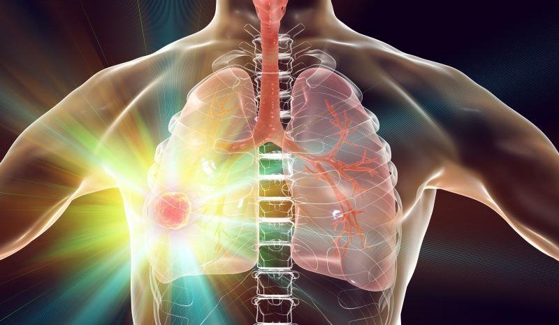 Alecensa Approved as First and Only ALK Inhibitor for Non-Small Cell Lung Cancer