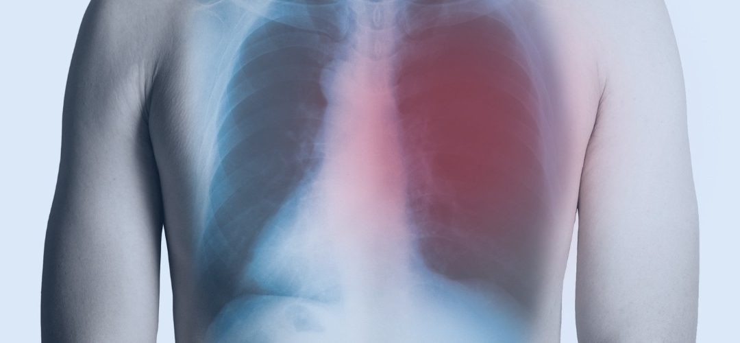 Low-Dose CT Screening Outperforms Chest Radiography in Reducing Lung Cancer Mortality