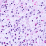 systemic mastocytosis Cells