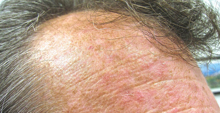 Assessing Tirbanibulin 1% Ointment's Efficacy in Treating Actinic Keratosis via D-OCT
