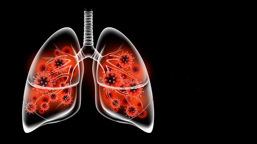 COVID-19-associated pulmonary aspergillosis
