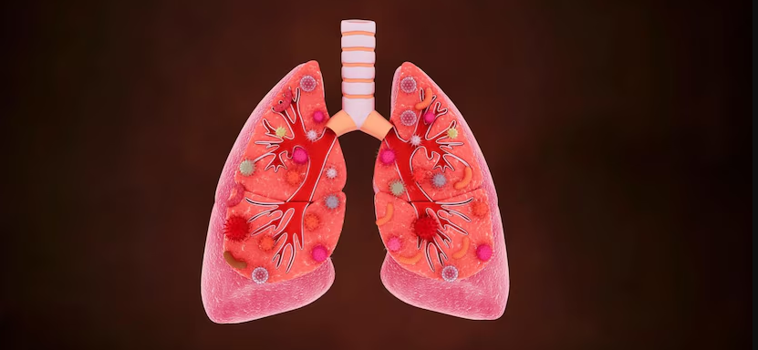 Native Lung Function in Patients with ILD: Navigating Post-SLTx Challenges