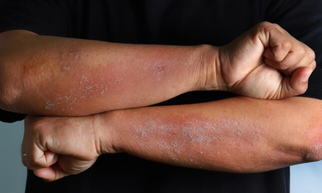 Safety and Efficacy of 2% Crisaborole Ointment in Adults Aged ≥45 with Stasis Dermatitis