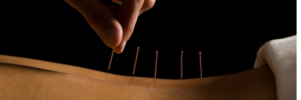 acupuncture being performed on back, spine, holistic, non-pharmacological treatment