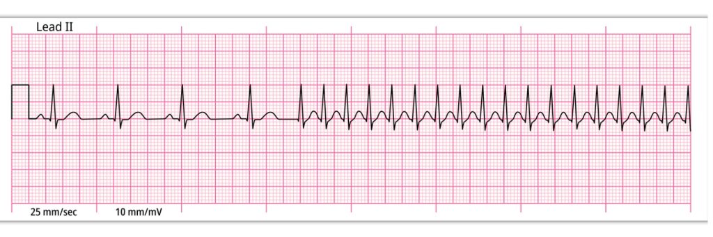 ECG Paroxysmal Supraventricular Tachycardia (PSVT) - 8 Second ECG