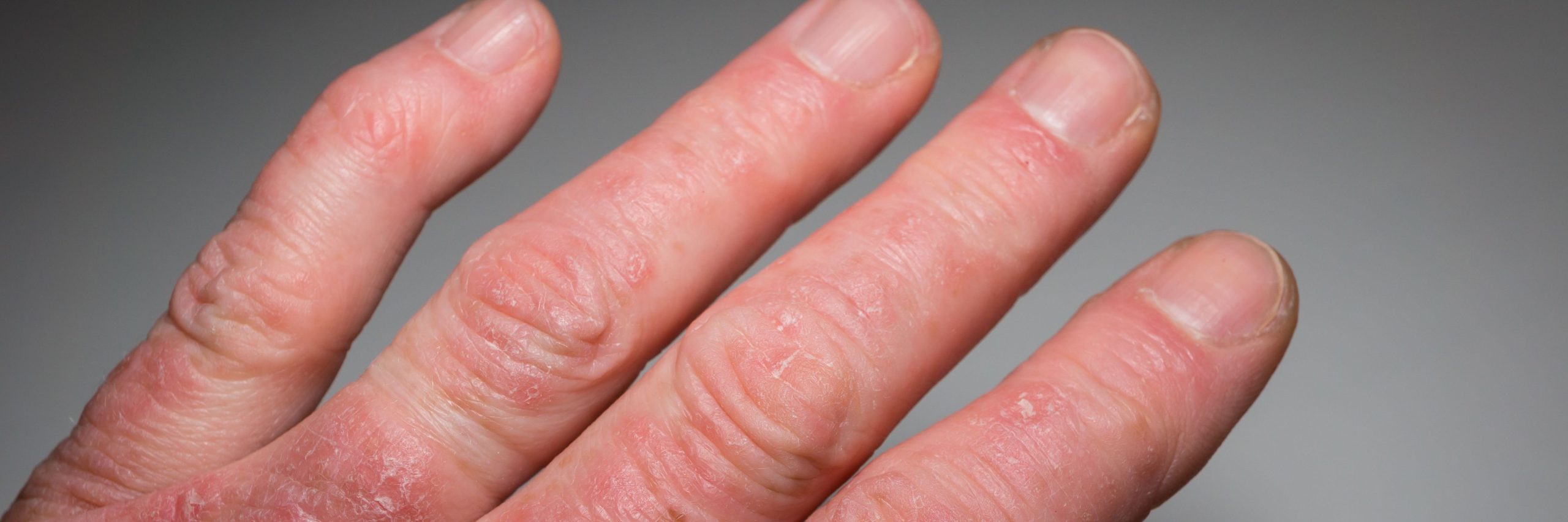 Coexistence of Psoriatic Arthritis and Atopic Dermatitis Offers Treatment Insights