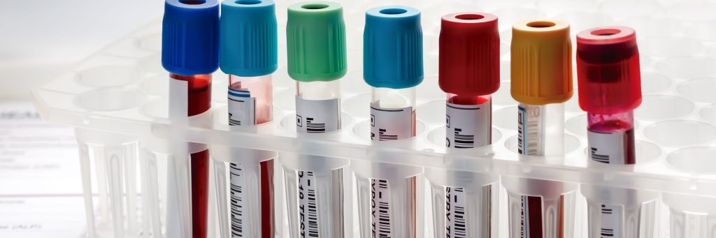 biomarker testing, Laboratory tray with collection of blood testing sample tubes for analysis. Rack of tubes with blood samples from patients in the hematology lab
