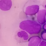 Acute myeloid leukemia (AML). Smear show shift maturation of then are blast cells, low N : C ratio, abundant cytoplasm, loose chromatin and prominent nucleoli. Thrombocytopenia