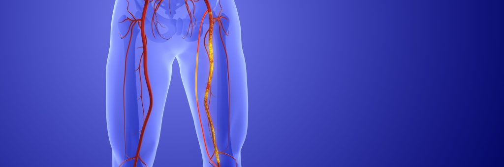 IVUS, Peripheral artery bypass surgery is done to re-route the blood supply around a blocked artery in the leg.