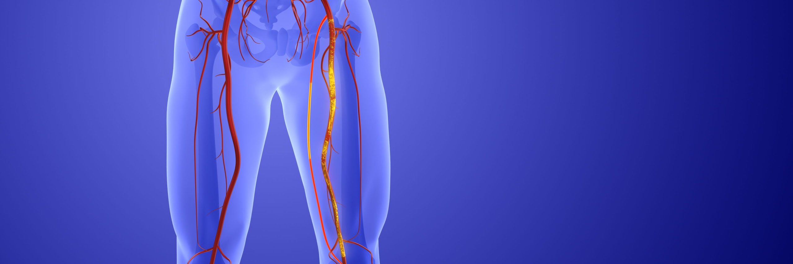 Peripheral Artery Disease: Procedure-Guidance by IVUS Superior to Angiography