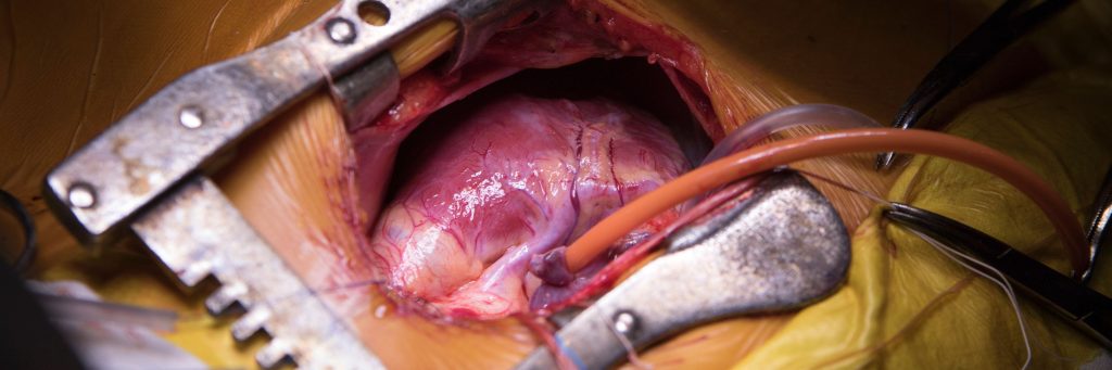 Three-year child heart with connected tubes of heart-assist device during the surgery, chest tube, cardiac surgery
