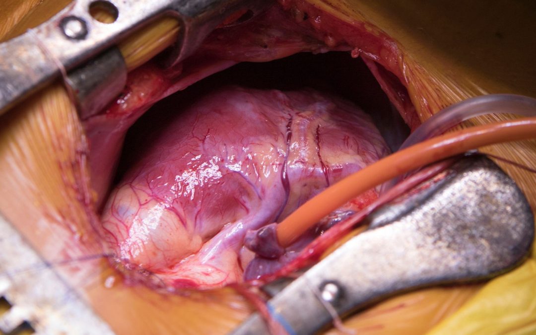 Virtual Reality Reduces Chest Tube Removal Pain During Cardiac Surgery