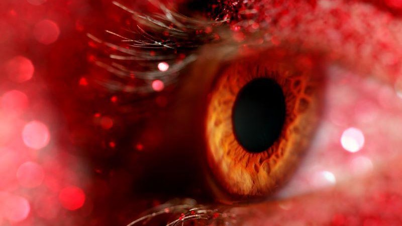 Study Identifies Factors Associated With Hydroxychloroquine Retinopathy