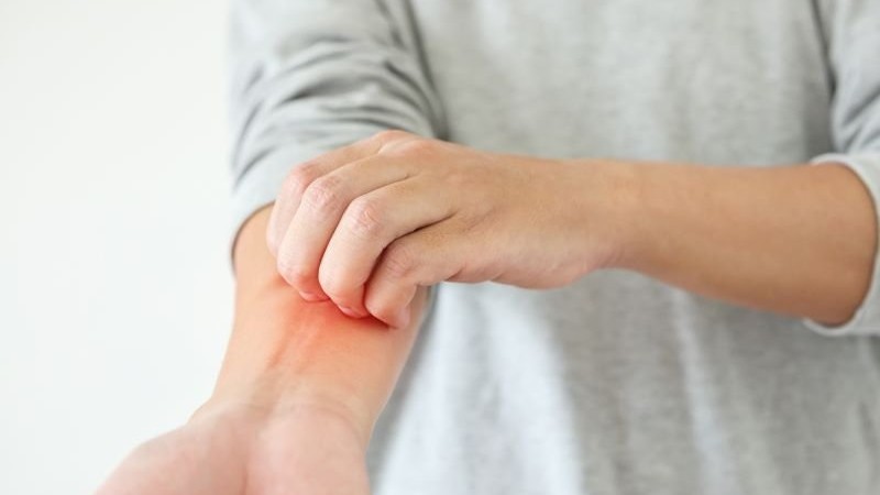 Coexistence of Psoriatic Arthritis, Atopic Dermatitis May Offer Treatment Insights