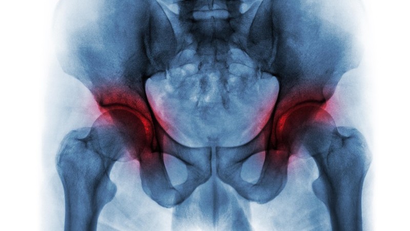 Worse Outcomes Seen for Severe Bilateral Hip OA in Adult Spinal Deformity