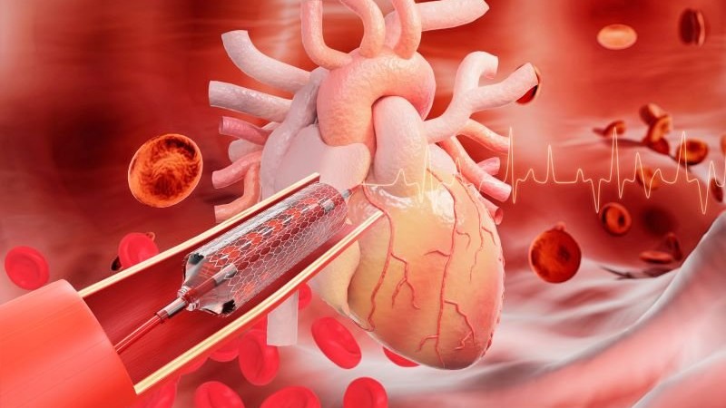 Radial Access for Percutaneous Coronary Intervention Now Dominant Method
