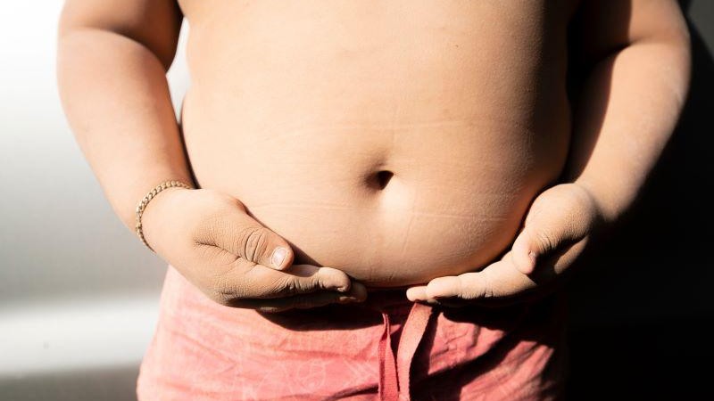 Acrochordons May Be Marker for Metabolic Disease in Children