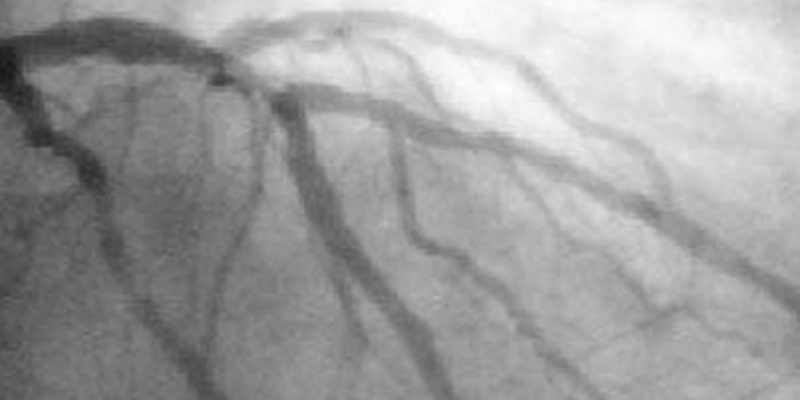 Intravascular ultrasound-guided stent insertion improves outcomes in patients with acute coronary syndrome