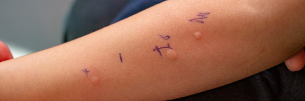 intradermal skin test, allergy, Skin Prick Allergy Test on a little child's arm, positive results