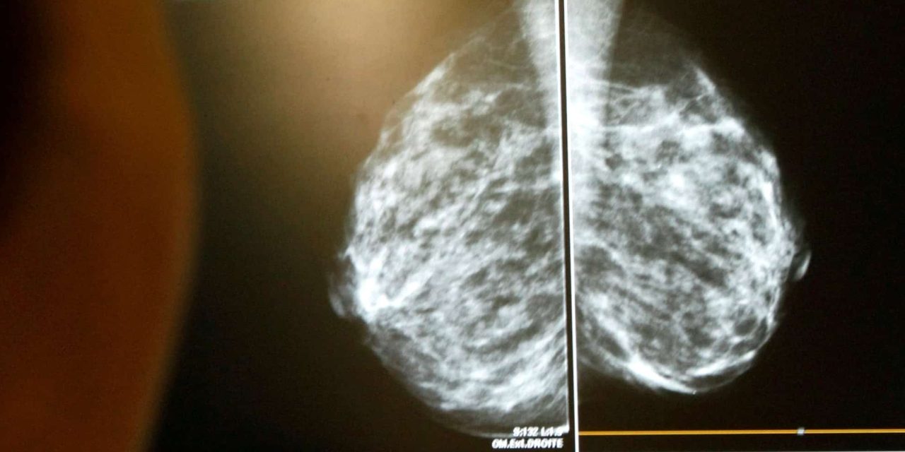 Many women with early-stage breast cancer can skip chemotherapy: study