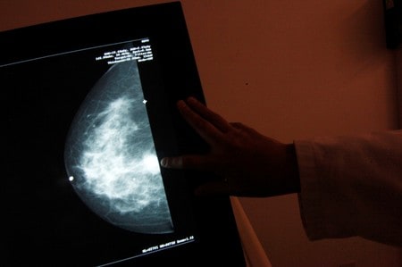 Advancing Personalized, Precision Breast Cancer Treatment