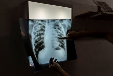 New tuberculosis treatment for developing countries to cost $1,040