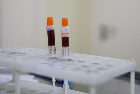 Blood Biomarkers May Assist in Diagnosing Schizophrenia With Tardive Dyskinesia